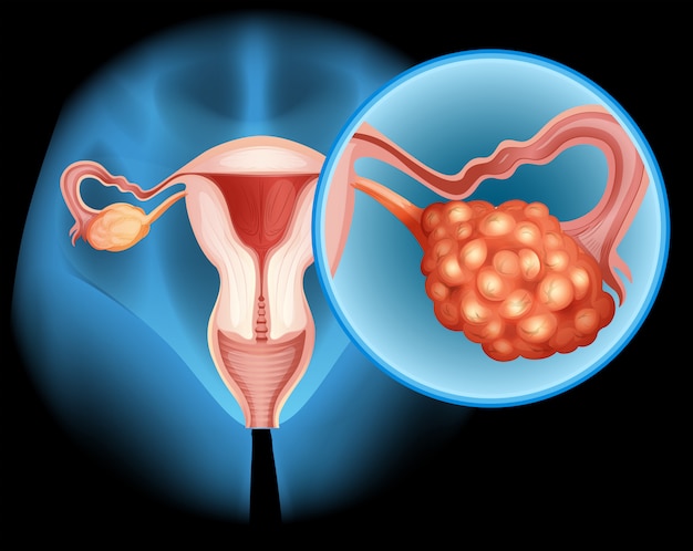 Diagrama de cáncer de ovario en detalle