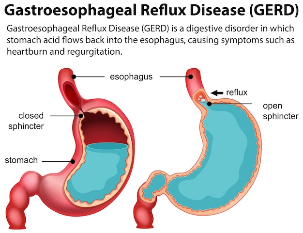 Vector gratuito diagrama de erge de la enfermedad por reflujo gastroesofágico