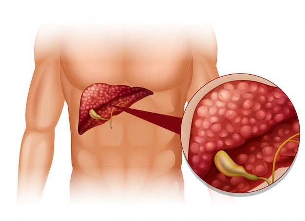 Diagrama de esclerosis en humanos