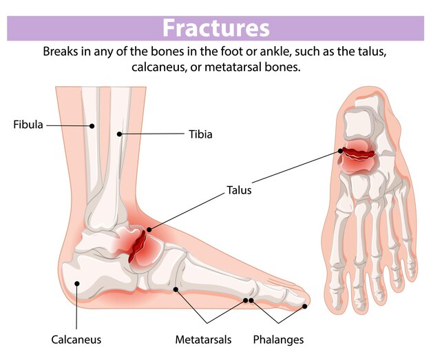 Diagrama de fracturas del pie y del tobillo