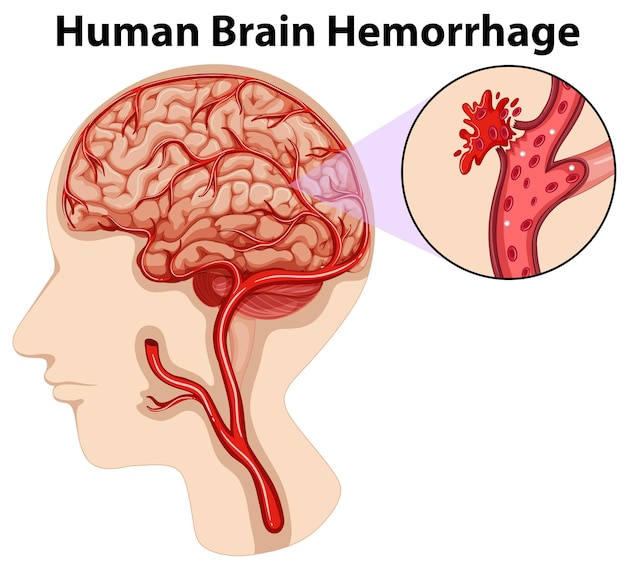 Vector gratuito diagrama de hemorragia cerebral humana