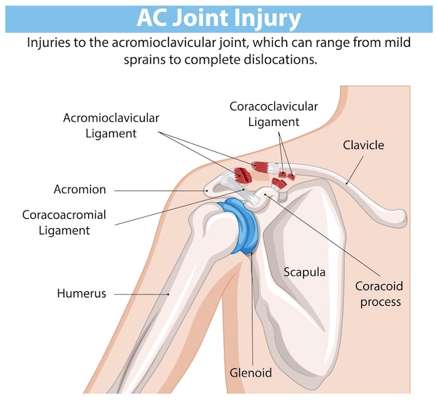 Diagrama de lesiones de la articulación AC