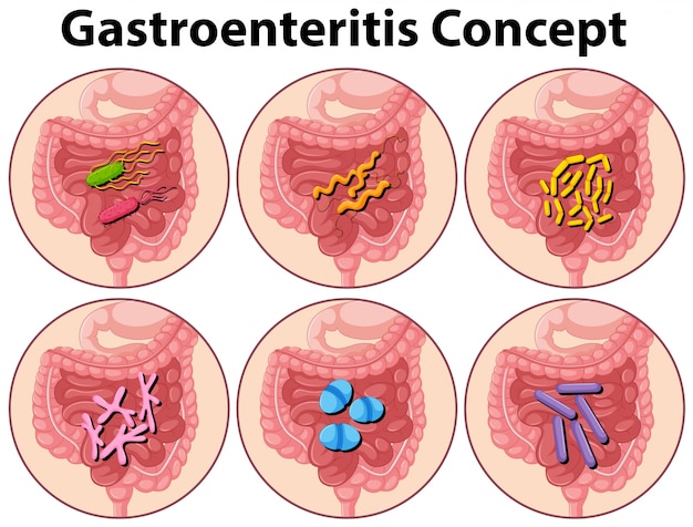 Vector gratuito diagrama mostrando la ilustración del concepto de gastroenteritis