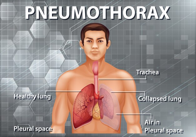 Diagrama de neumotórax de anatomía humana