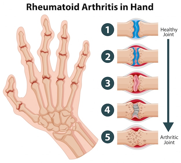 Diagrama que muestra la artritis reumatoide en una mano