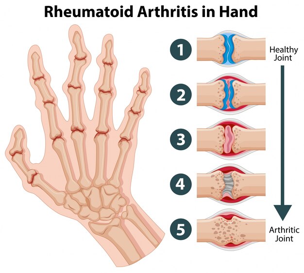 Diagrama que muestra la artritis reumatoide en una mano