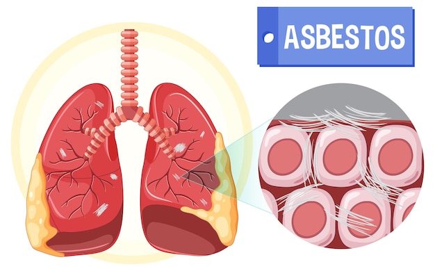 Vector gratuito diagrama que muestra la asbestosis en los pulmones