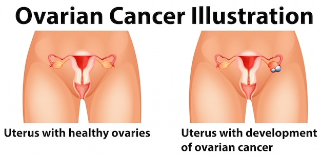 Diagrama que muestra el cáncer de ovario en humanos