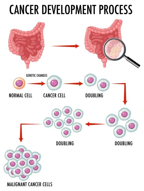 Diagrama que muestra células normales y cancerosas en humanos