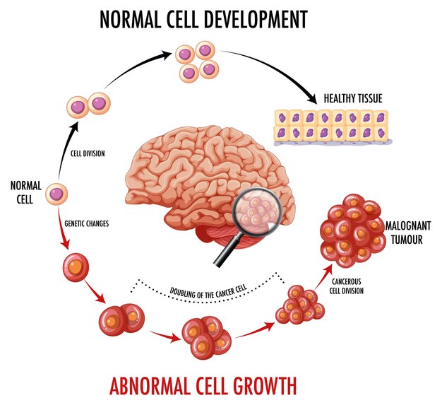 Diagrama que muestra el cerebro humano y el cáncer