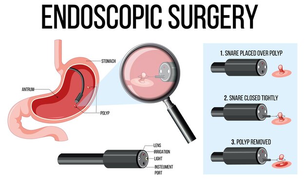 Vector gratuito diagrama que muestra la cirugía endoscópica