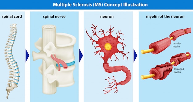 Diagrama que muestra el concepto de esclerosis múltiple