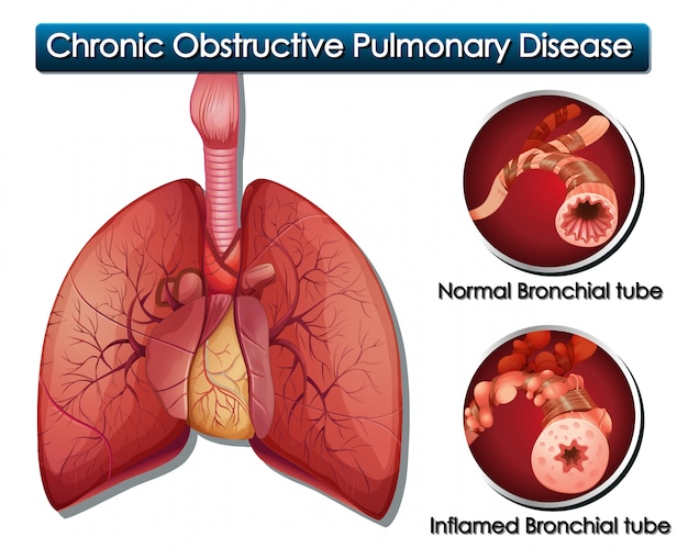 Diagrama que muestra enfermedad pulmonar obstructiva crónica