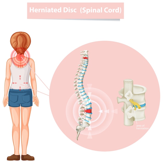 Diagrama que muestra la hernia de disco