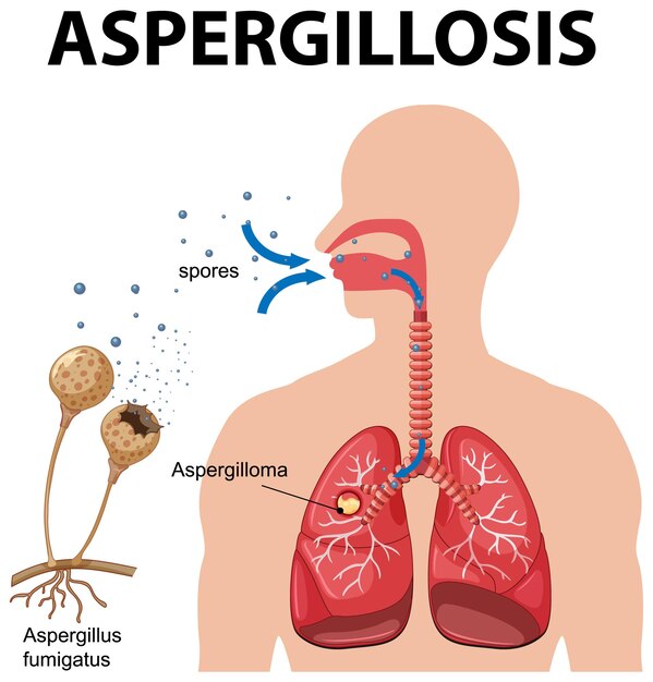 Diagrama que muestra la infección por aspergillus