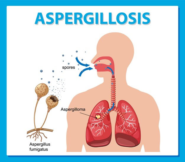 Diagrama que muestra la infección por aspergillus