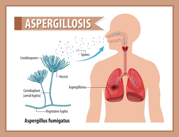 Diagrama que muestra la infección por aspergillus