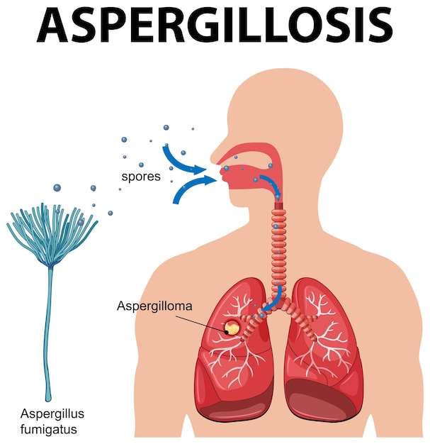 Vector gratuito diagrama que muestra la infección por aspergillus