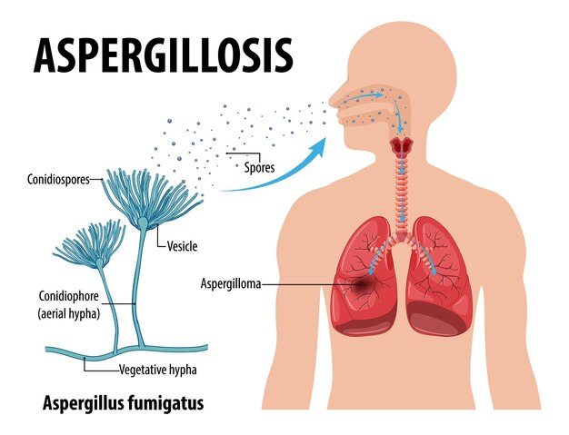 Diagrama que muestra la infección por aspergillus