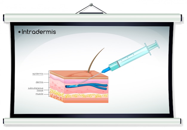 Diagrama que muestra la inyección de intradermis