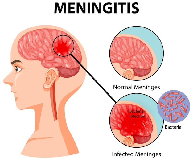 Diagrama que muestra la meningitis en el cerebro humano