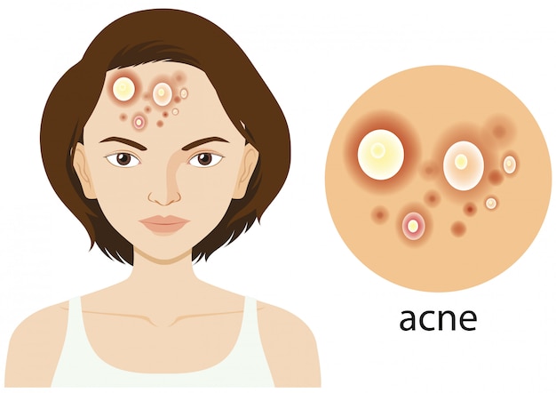 Diagrama que muestra a la mujer con problemas de acné