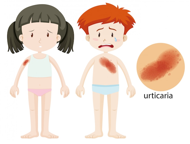 Vector gratuito diagrama que muestra niño y niña con urticaria