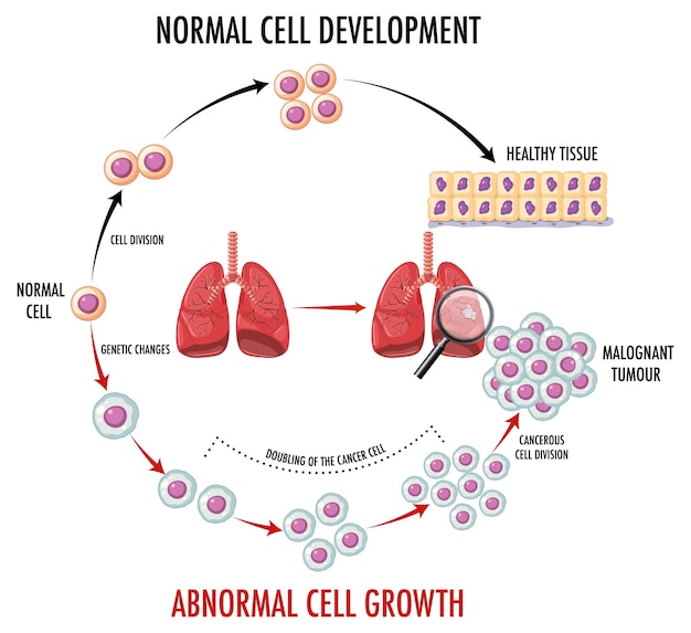Diagrama que muestra el proceso de desarrollo del cáncer