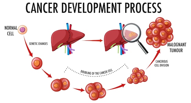 Diagrama que muestra el proceso de desarrollo del cáncer