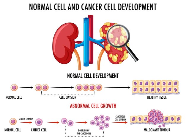 Diagrama que muestra el proceso de desarrollo del cáncer