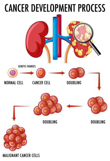 Diagrama que muestra el proceso de desarrollo del cáncer