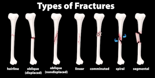 Vector gratuito diagrama de tipo de fracturas