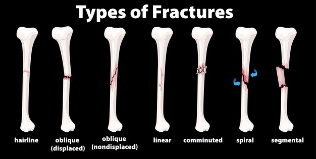 Diagrama de tipo de fracturas