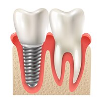 Vector gratuito diente de implante dental conjunto primer modelo