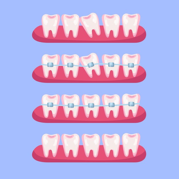 Dientes antes y después del conjunto de ilustración de dibujos animados de aparatos ortopédicos. Etapas de alineación dental o tratamiento con uso de brackets para una hermosa sonrisa. Ortodoncista, salud, concepto de medicina.