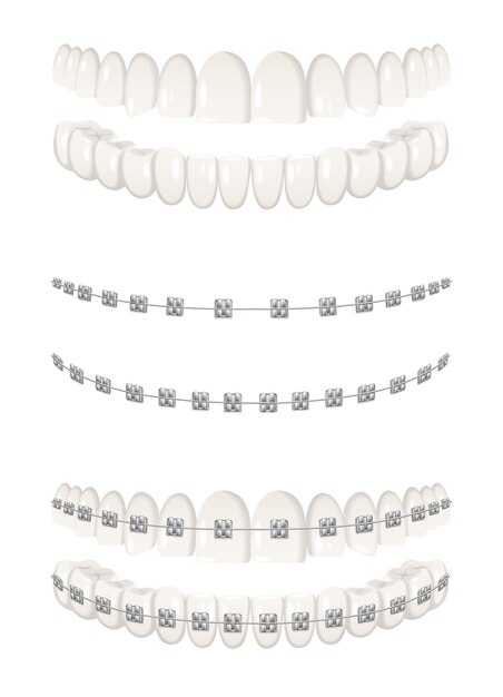 Dientes aparatos dentales iconos realistas conjunto ilustración vectorial aislado