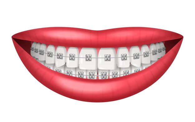 Dientes aparatos dentales realistas aislados en la ilustración de vector de fondo blanco