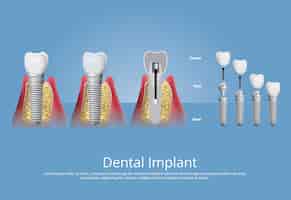 Vector gratuito dientes humanos e implantes dentales ilustración vectorial