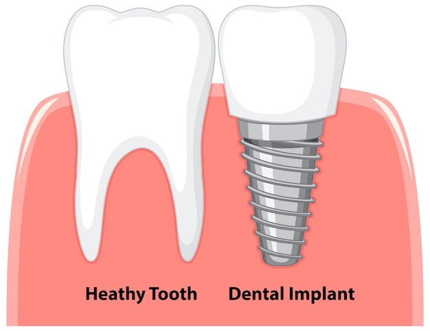 Dientes sanos e implantes dentales en las encías sobre fondo blanco