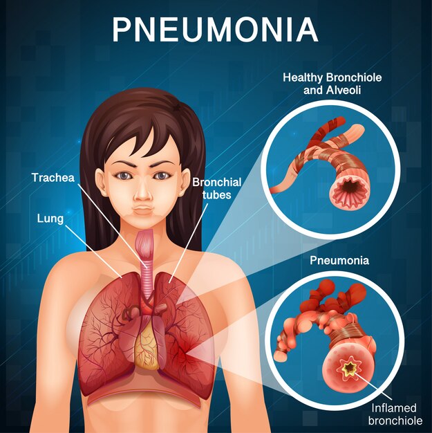 Diseño de cartel para la neumonía con pulmones humanos