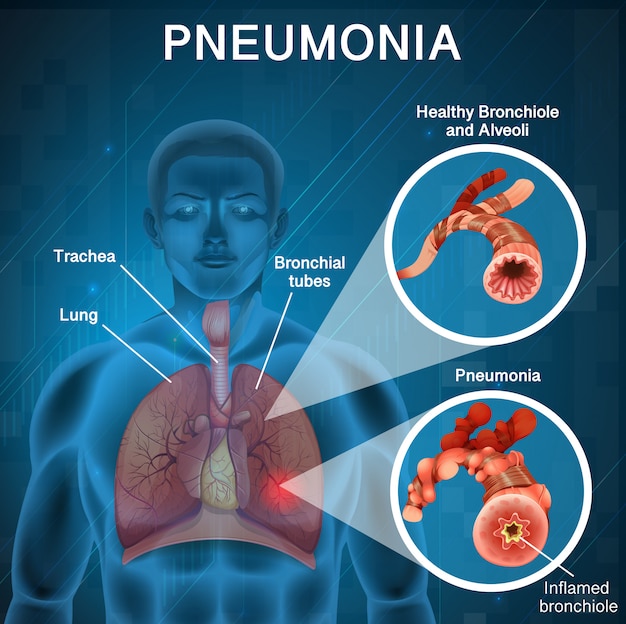 Vector gratuito diseño de póster para neumonía con pulmones humanos y malos