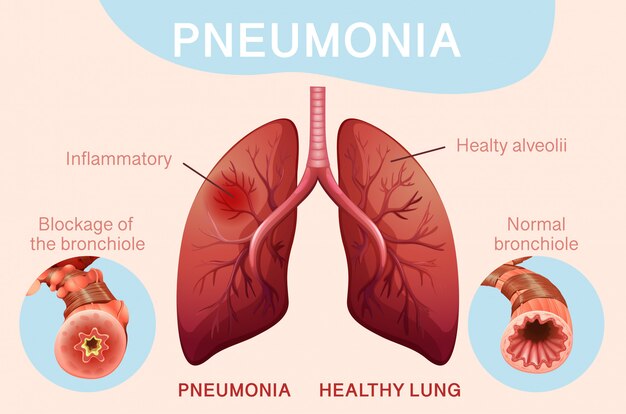 Diseño de póster para neumonía con pulmones humanos