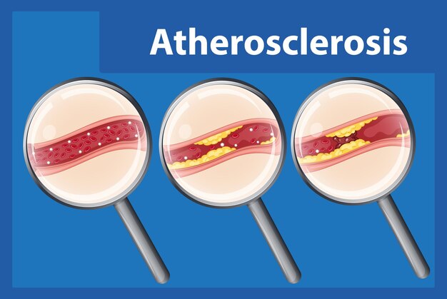 Educación científica Anatomía humana y desarrollo de la aterosclerosis