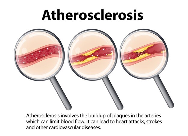 Educación científica Anatomía humana y desarrollo de la aterosclerosis