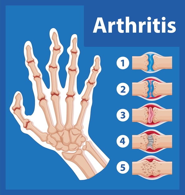 Vector gratuito educación científica anatomía humana y etapas de la artritis