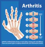 Vector gratuito educación científica sobre la anatomía humana etapas de la artritis en la mano infografía