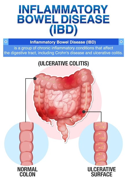 Enfermedad Inflamatoria Intestinal EII Infografía