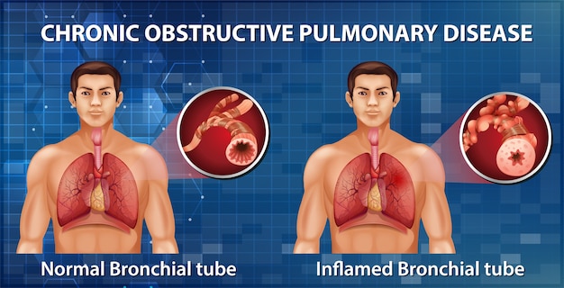 Vector gratuito enfermedad pulmonar obstructiva crónica