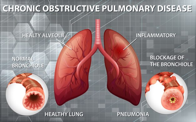 Enfermedad pulmonar obstructiva crónica