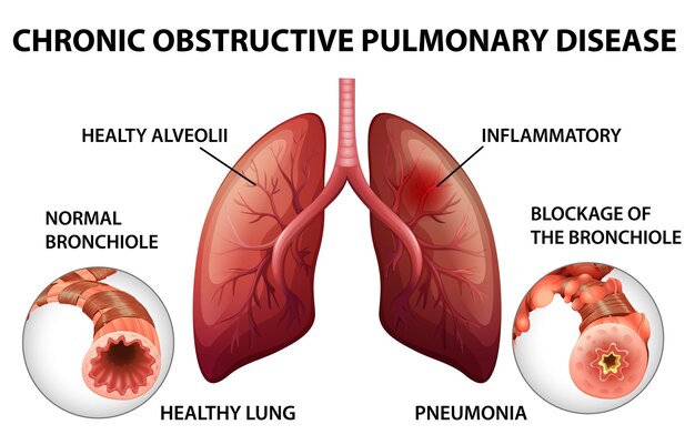 Enfermedad pulmonar obstructiva crónica